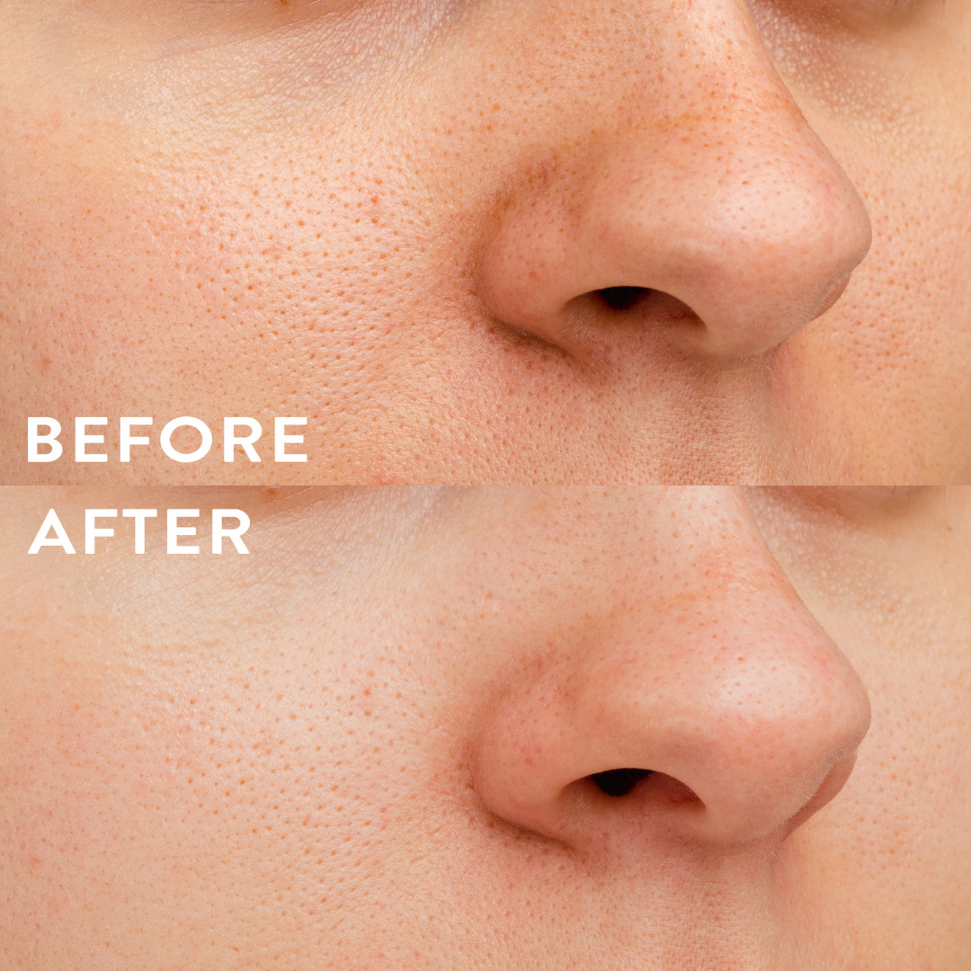 Hydro-Patch flat lay next to cleanser and toner for the full blackhead-focused routine