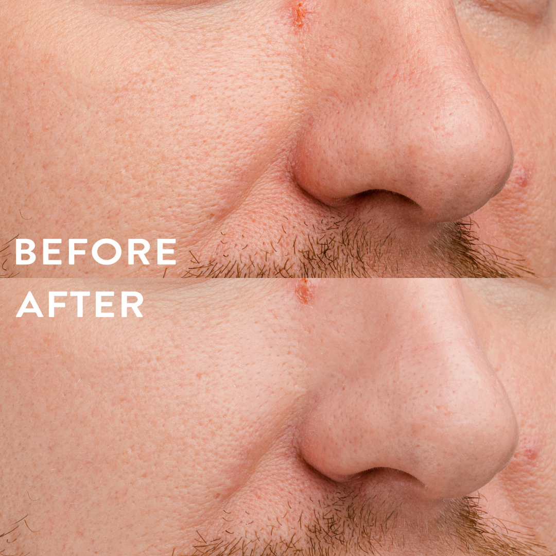 Nose patch applied on skin overnight to help lift blackheads and absorb excess sebum